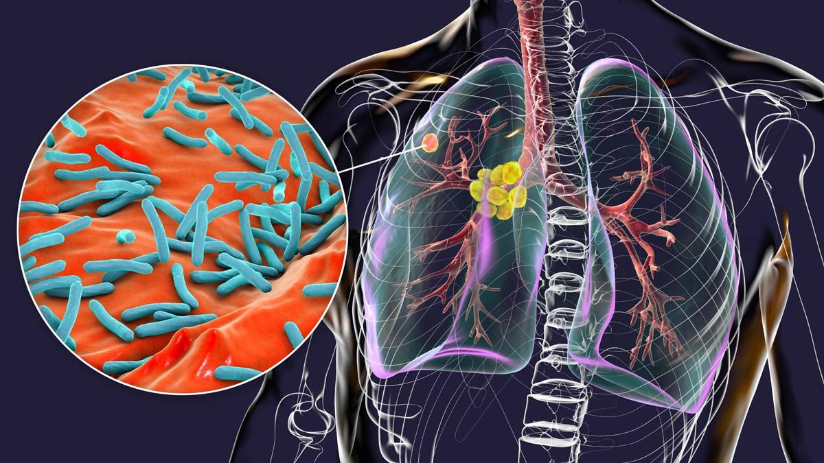 Dünya Sağlık Örgütü uyardı: Vaka sayılarında rekor artış
