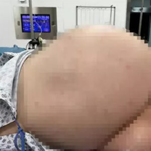 Hastadan 26 kiloluk tümör çıkardı: Literatürde hiç göremedim