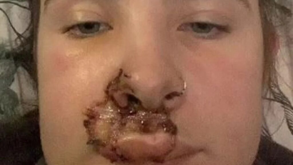 İngiltere’de otobüste seyahat eden genç kızın yüzünü ısırdı: 50 dikiş atıldı