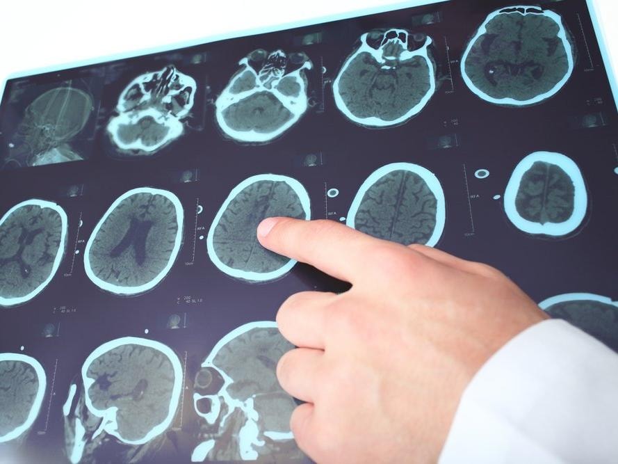 Kadınlarda daha fazla görülüyor… Dikkat çeken belirtileriyle: MS