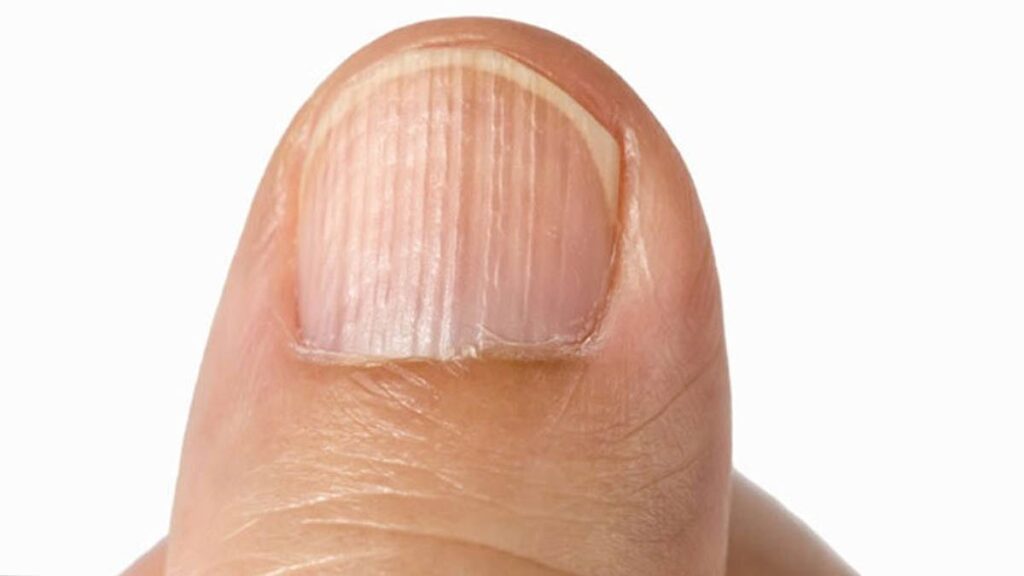 Tırnaktaki dikey çizgiler ne anlama geliyor? Vitamin eksikliği belirtisi sanılıyordu! İşte yanıtı