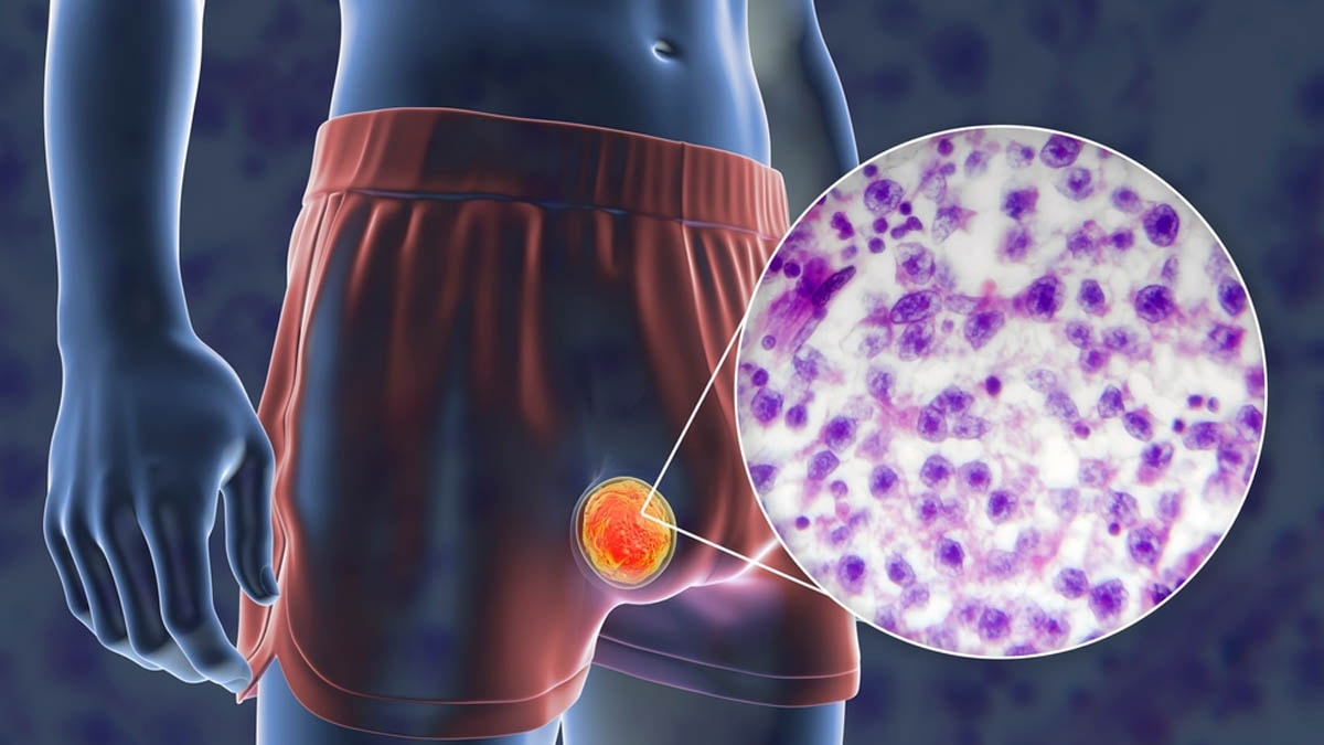 Basit ışık testiyle erkeklerde kanser tespiti: Erkekler genellikle göz ardı ediyor