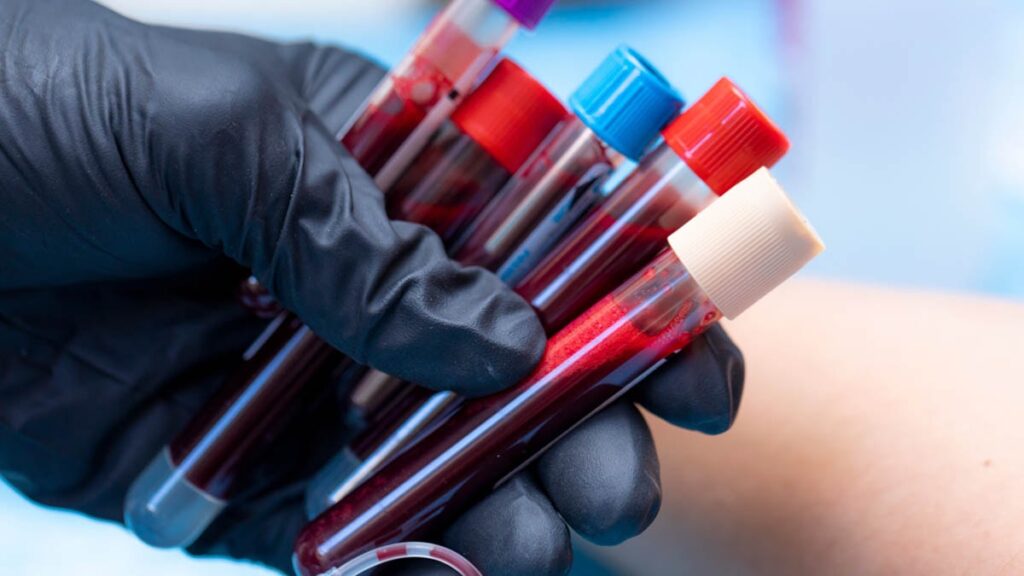 Bu kan grubuna sahip olanlar 60 yaşından önce felç geçirme riski taşıyor!