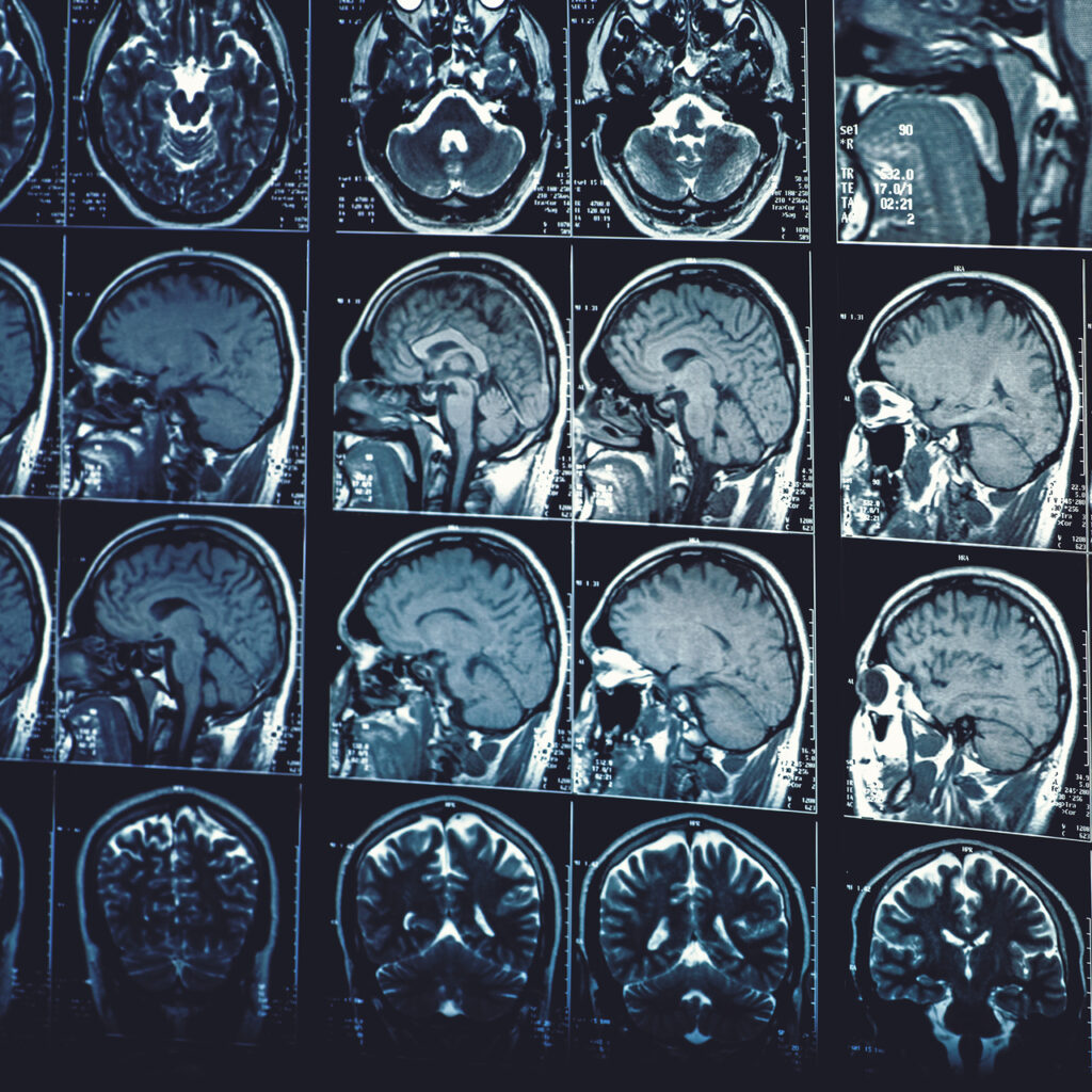 İnme ve beyin hasarı sonrası yeni bir yaşama adım attılar