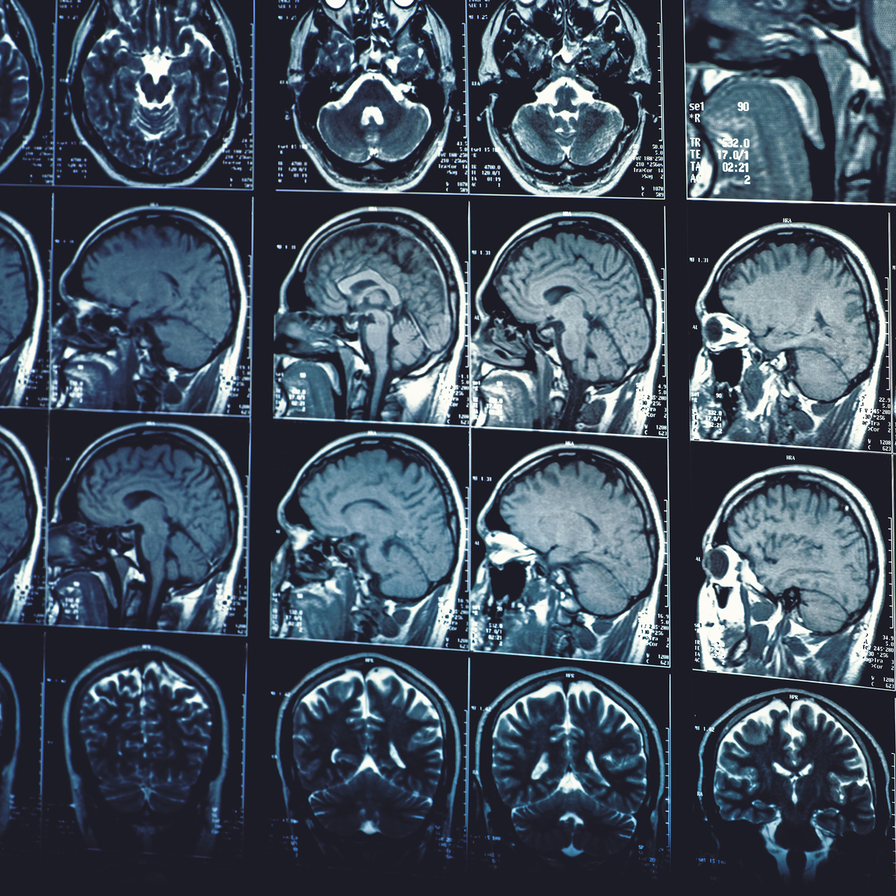 İnme ve beyin hasarı sonrası yeni bir yaşama adım attılar