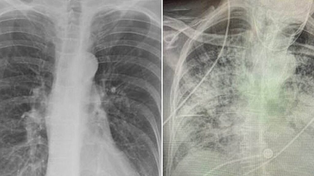 Sigarayı bıraktıktan sonra akciğerin kendini yenilemesi ne kadar sürer? Aşama aşama açıklandı