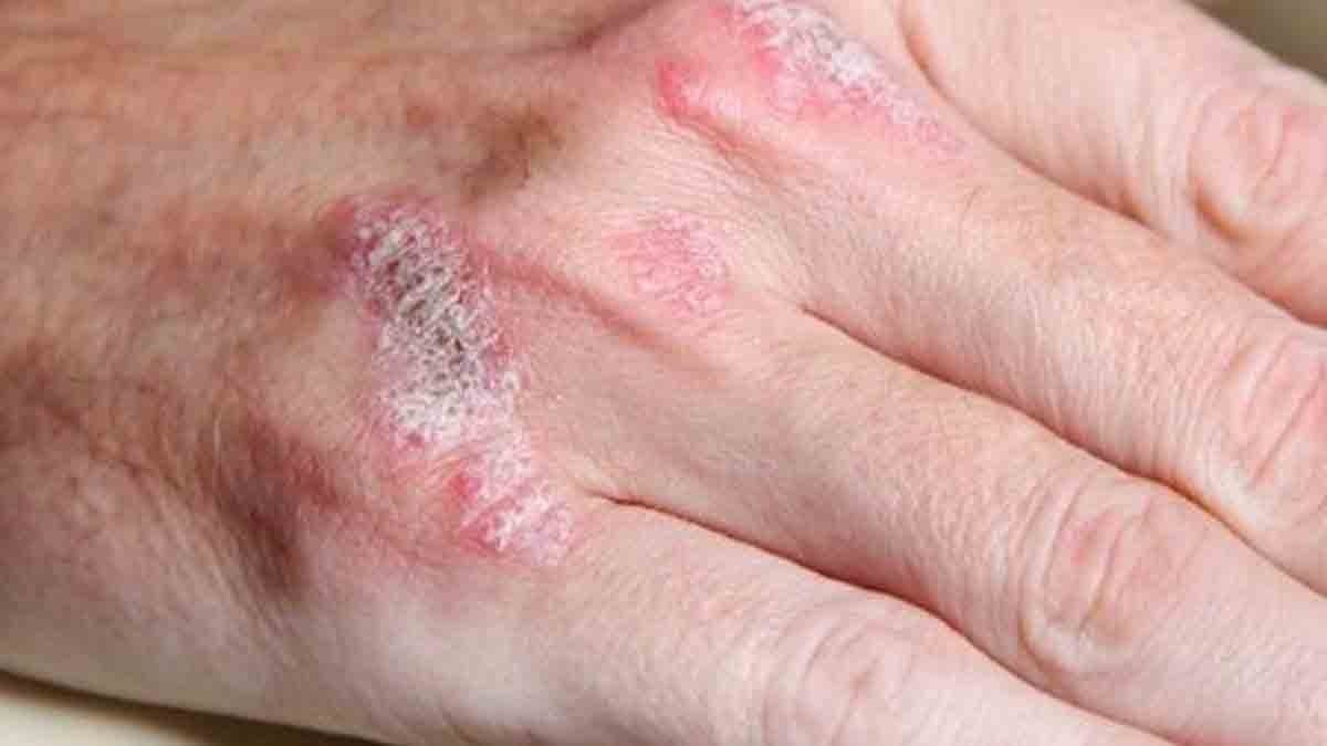 Bu yiyecekler doğrudan sedef hastalığıyla bağlantılı olabilir: Fransız dermatologlar araştırdı