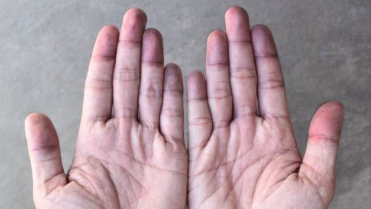 Ellerinize dikkat edin! Hastalıkların ilk belirtisi tırnaklarda görülüyor…