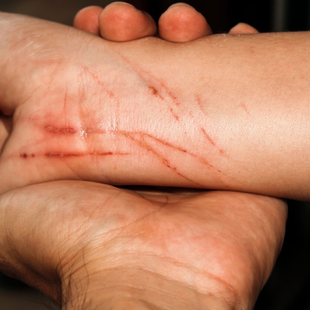 Kuduz ne zaman ölümcül?