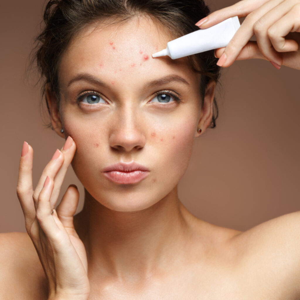 Kurutucu akne tedavisinde bilinmesi gerekenler!