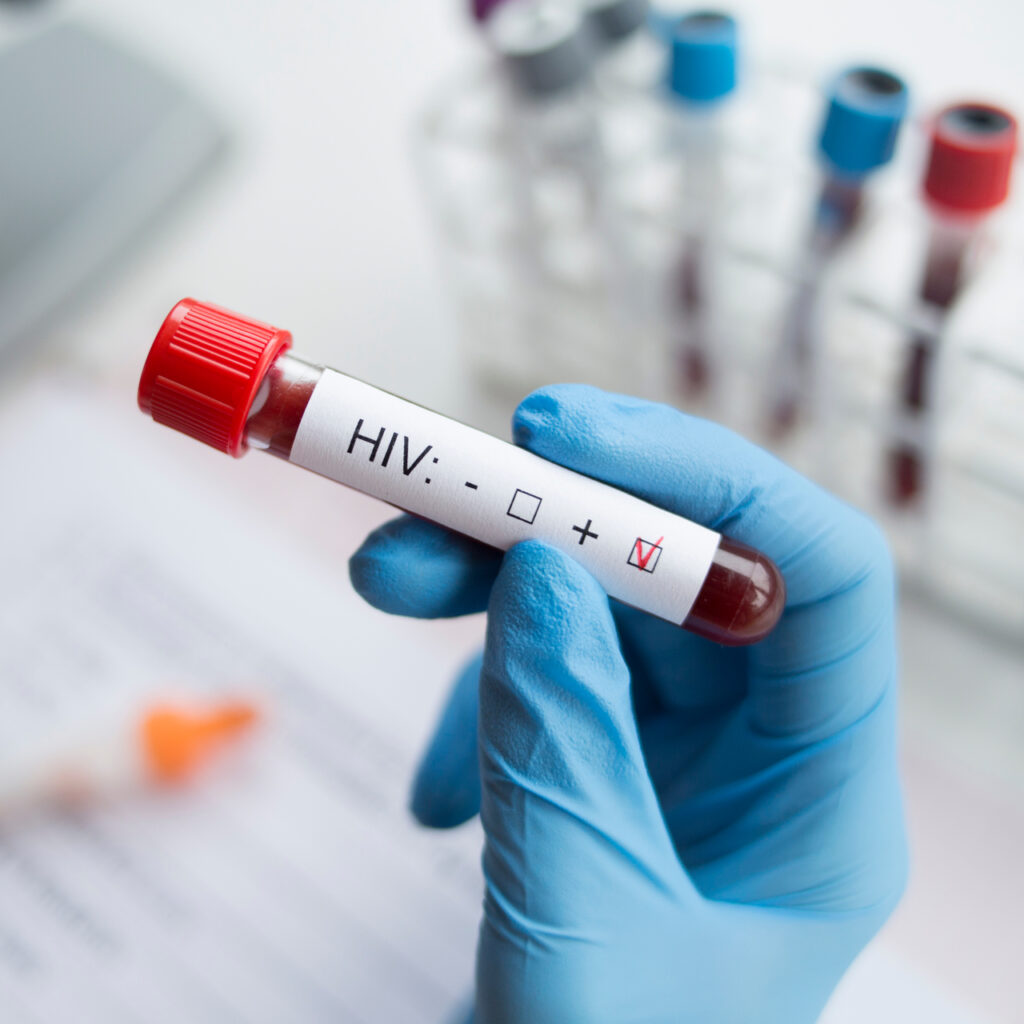 Önyargılar HIV ile mücadeleyi baltalıyor