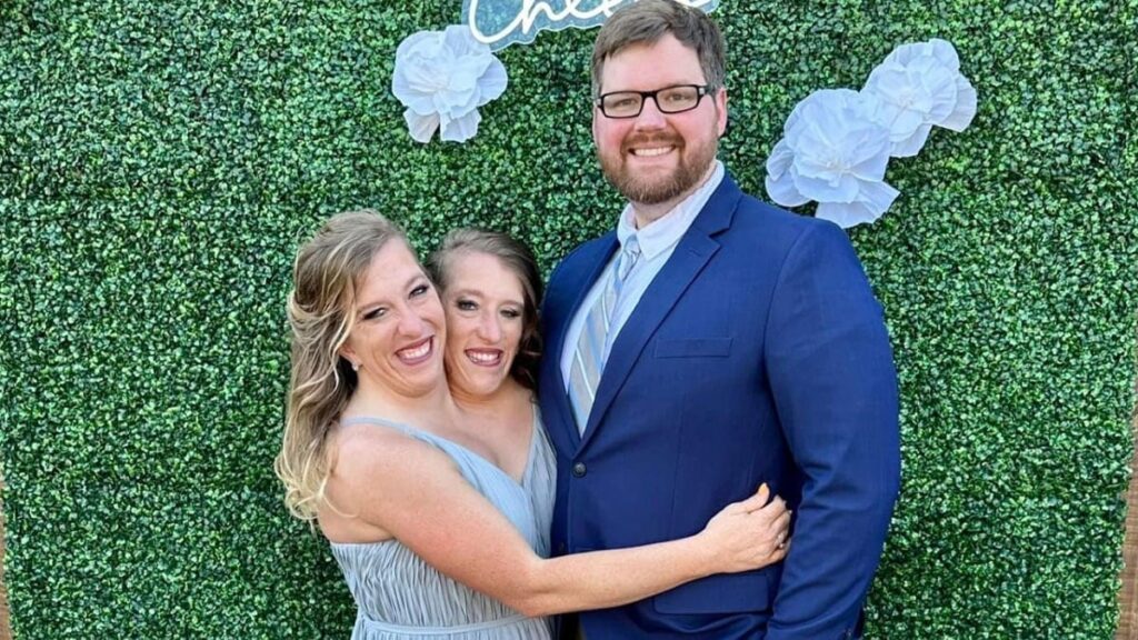 Yapışık ikizlerin ‘hamileliği’ ortalığı karıştırdı