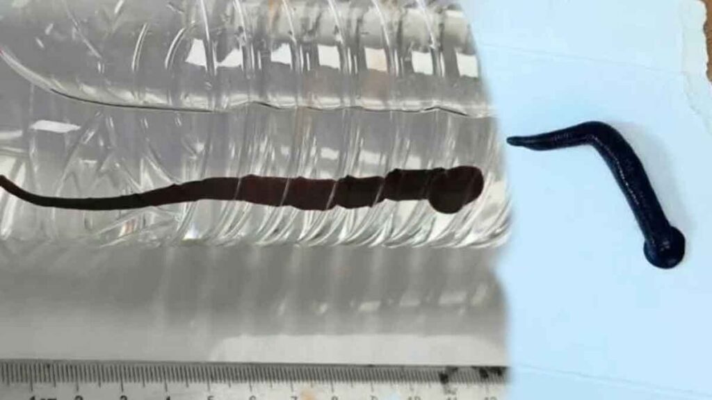 7 yaşındaki çocuğun akciğerinde 12 santimetrelik sülük bulundu