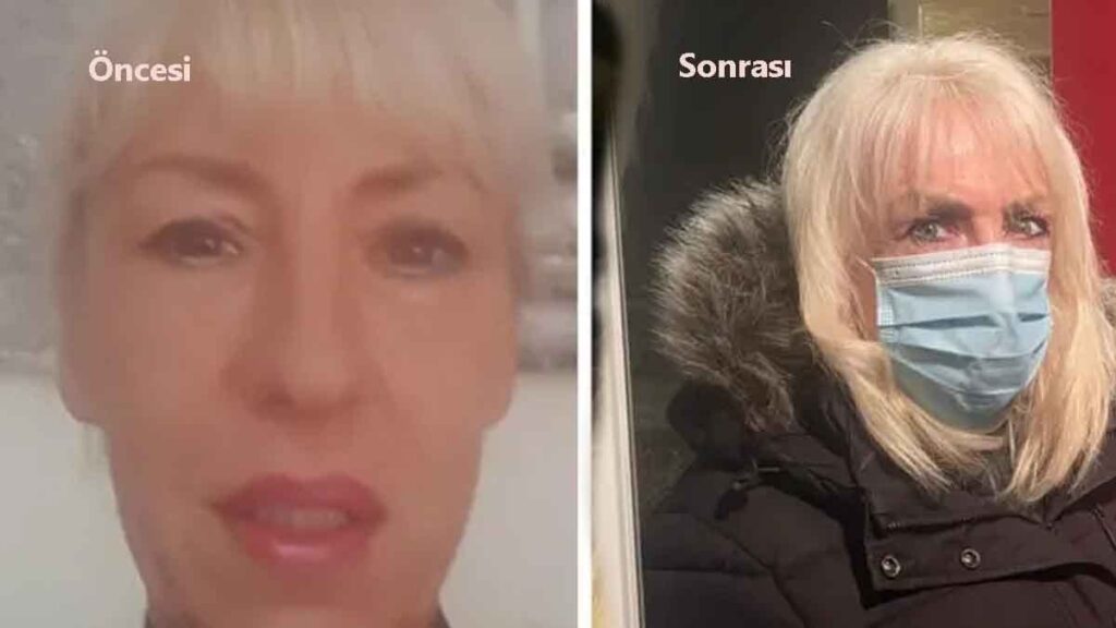 ‘Çirkin yaratık gibi görünüyorum’ Dolgulara binlerce dolar harcadı, yüzü tanınmaz halde