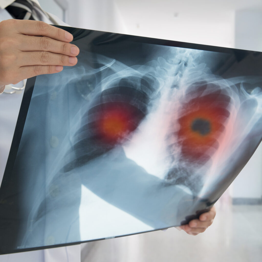 Verem ilacını aksatmayana 9 bin lira