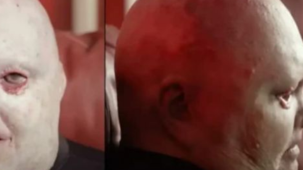 43 yıldır yüzü oluk oluk kanıyor