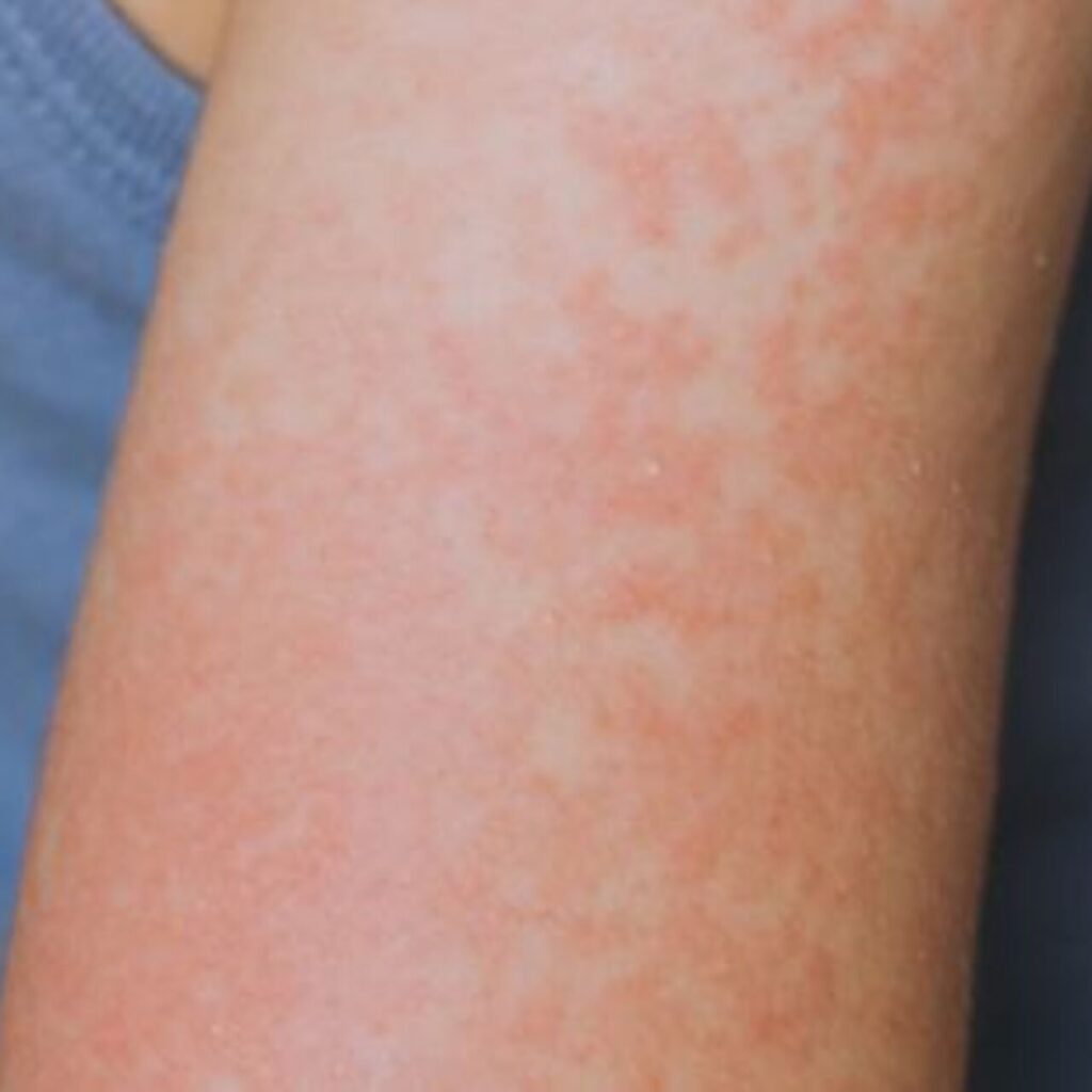 ABD’nin Teksas eyaletinde 48 kızamık vakası bildirildi