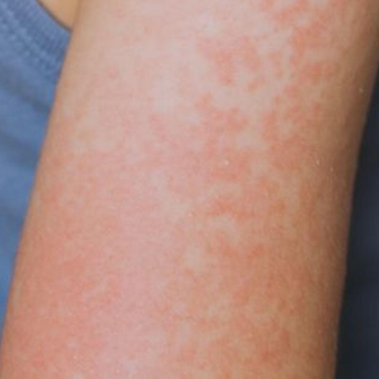 Teksas’ta 48 kızamık vakası bildirildi