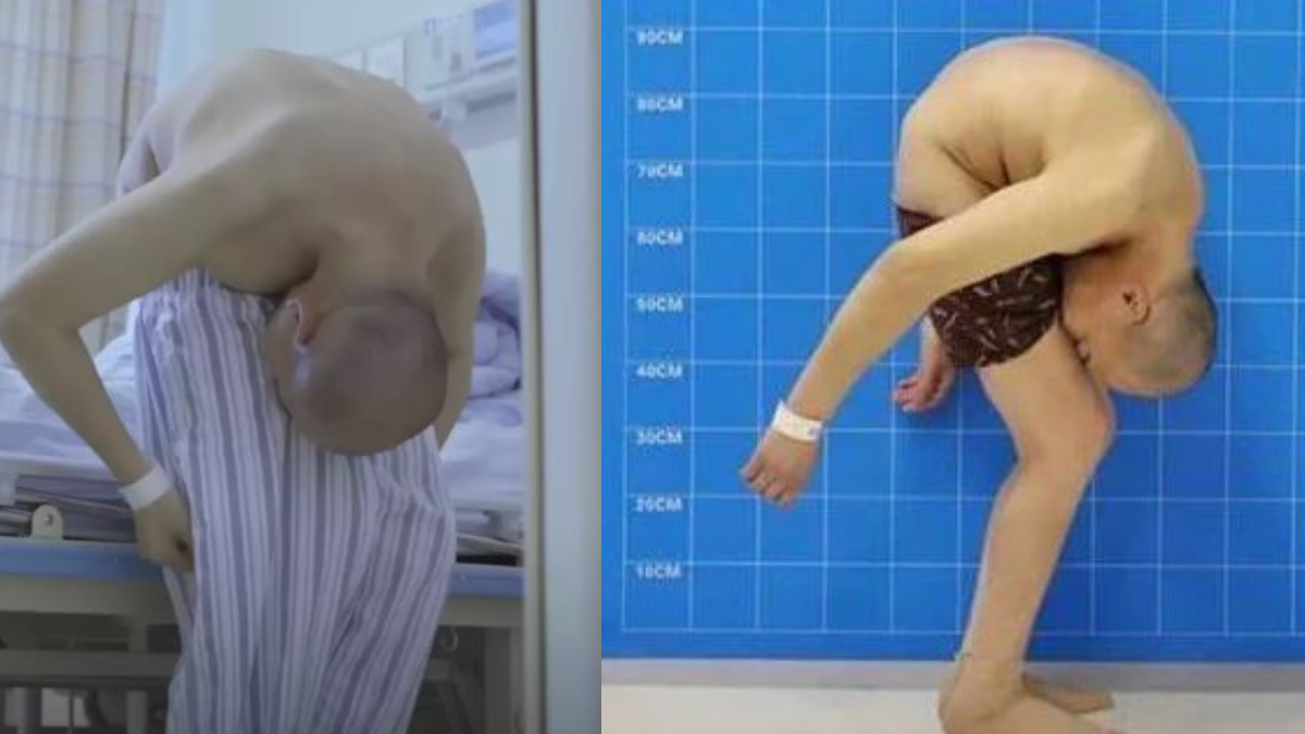 Bacak arasından yemek yiyen adamın son hali inanılmaz: 30 yıl kat kat yaşamıştı