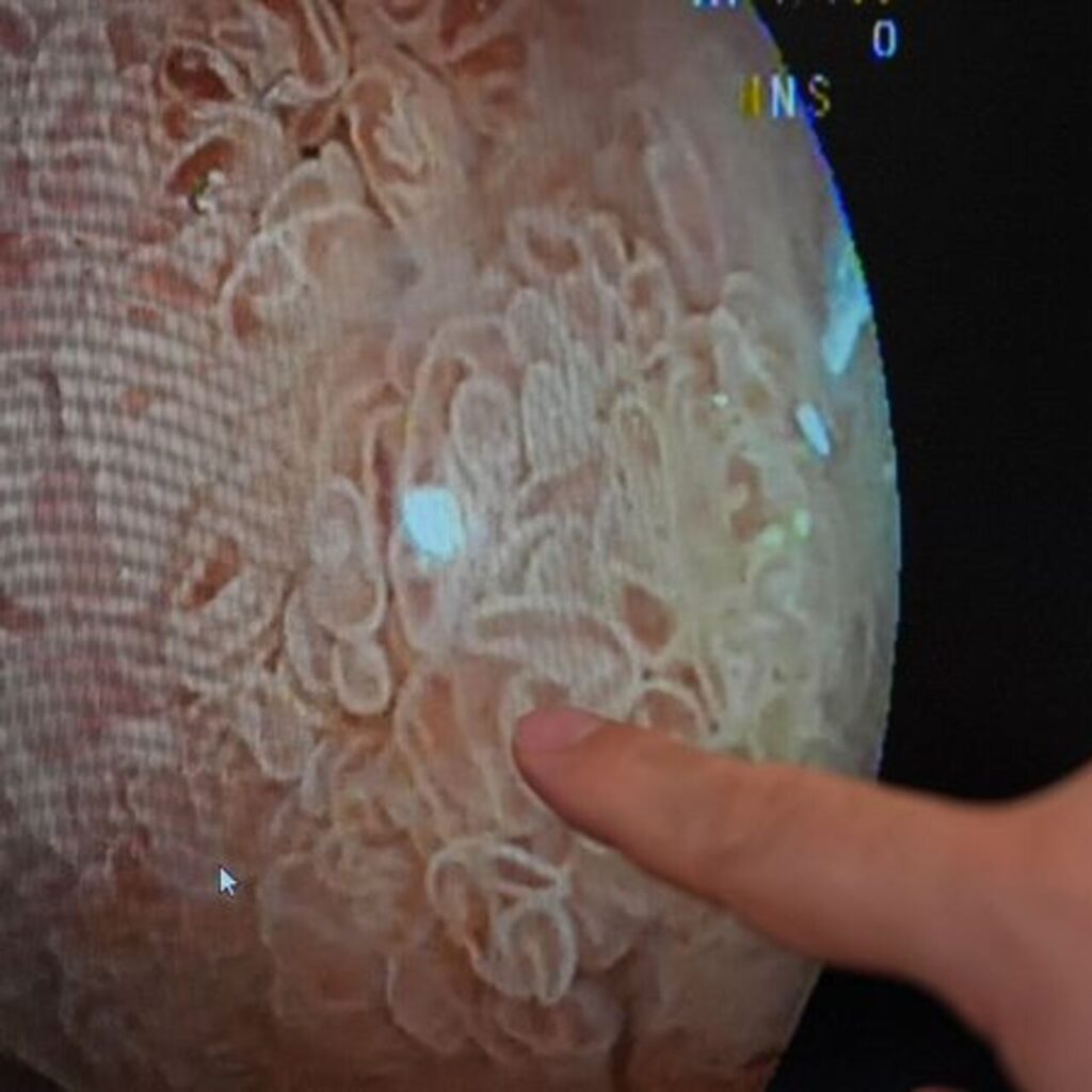 Diz ve kalça ağrısıyla gitti, bağırsak kanseri olduğunu öğrendi