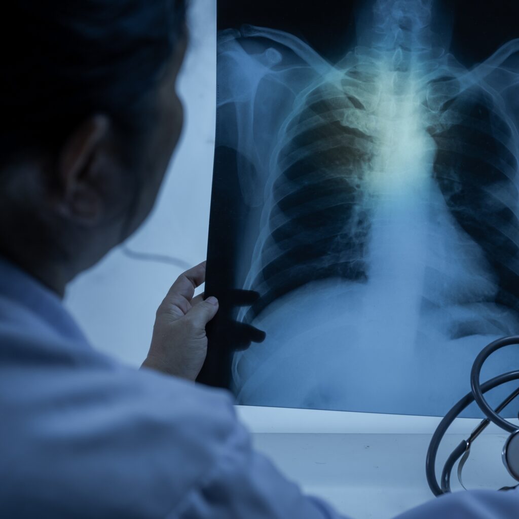 Kanser yükü artıyor! 2050’de vaka sayısı ikiye katlanabilir