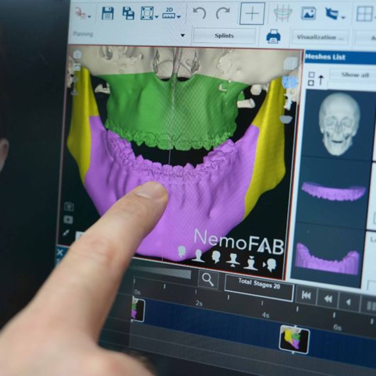 Tek yumurta ikizlerine, 3 boyutlu modellemeyle çene ameliyatı