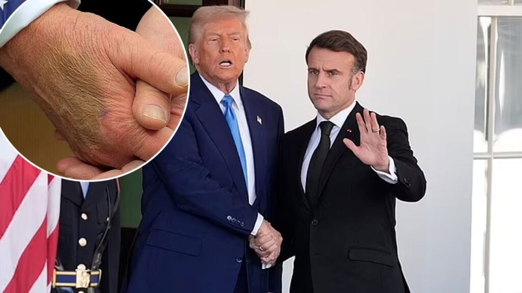 Trump’ın elindeki morluk dikkat çekti: Sağlığıyla ilgili ne saklanıyor?