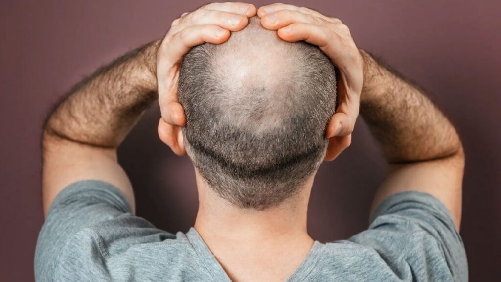 Yemeklerin asırlık eşlikçileri meğer saçları döküyormuş