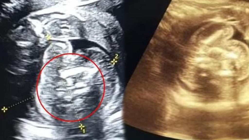 Yeni doğan bebeğin içinden 2 fetüs çıktı: Doktorlar şaşkına döndü