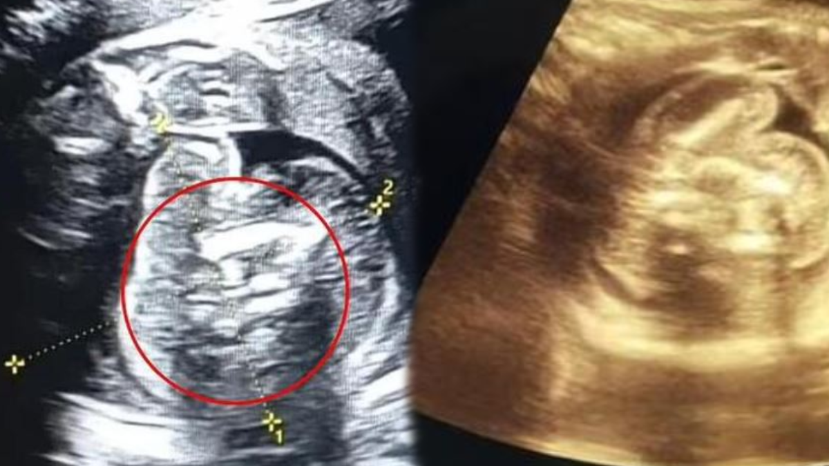 Yeni doğan bebeğin içinden 2 fetüs çıktı: Doktorlar şaşkına döndü