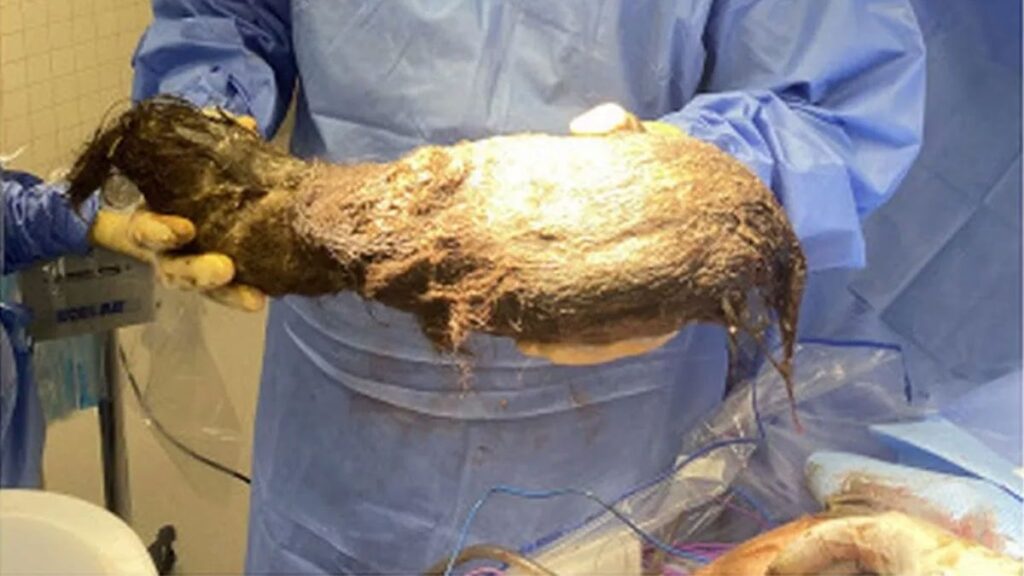 "Rapunzel sendromu" yaşadı; midesinden 2.5 kilo saç çıktı