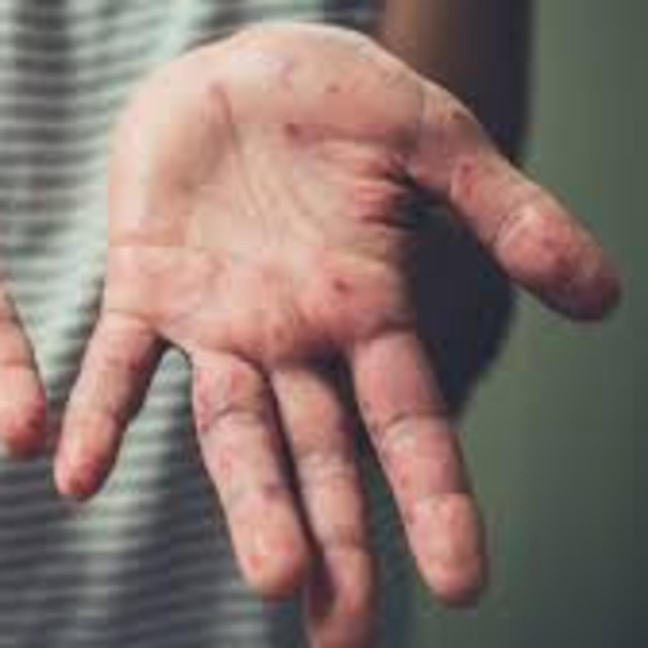 ABD’nin Kansas eyaletinde 23 kızamık vakası bildirildi