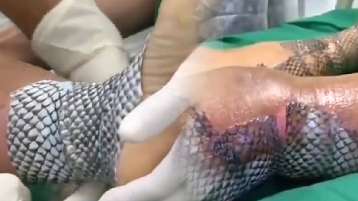 En zorlu tedavilerden birini Brezilyalılar çözdü: Tuhaf görünmesine rağmen sonuçları çok başka