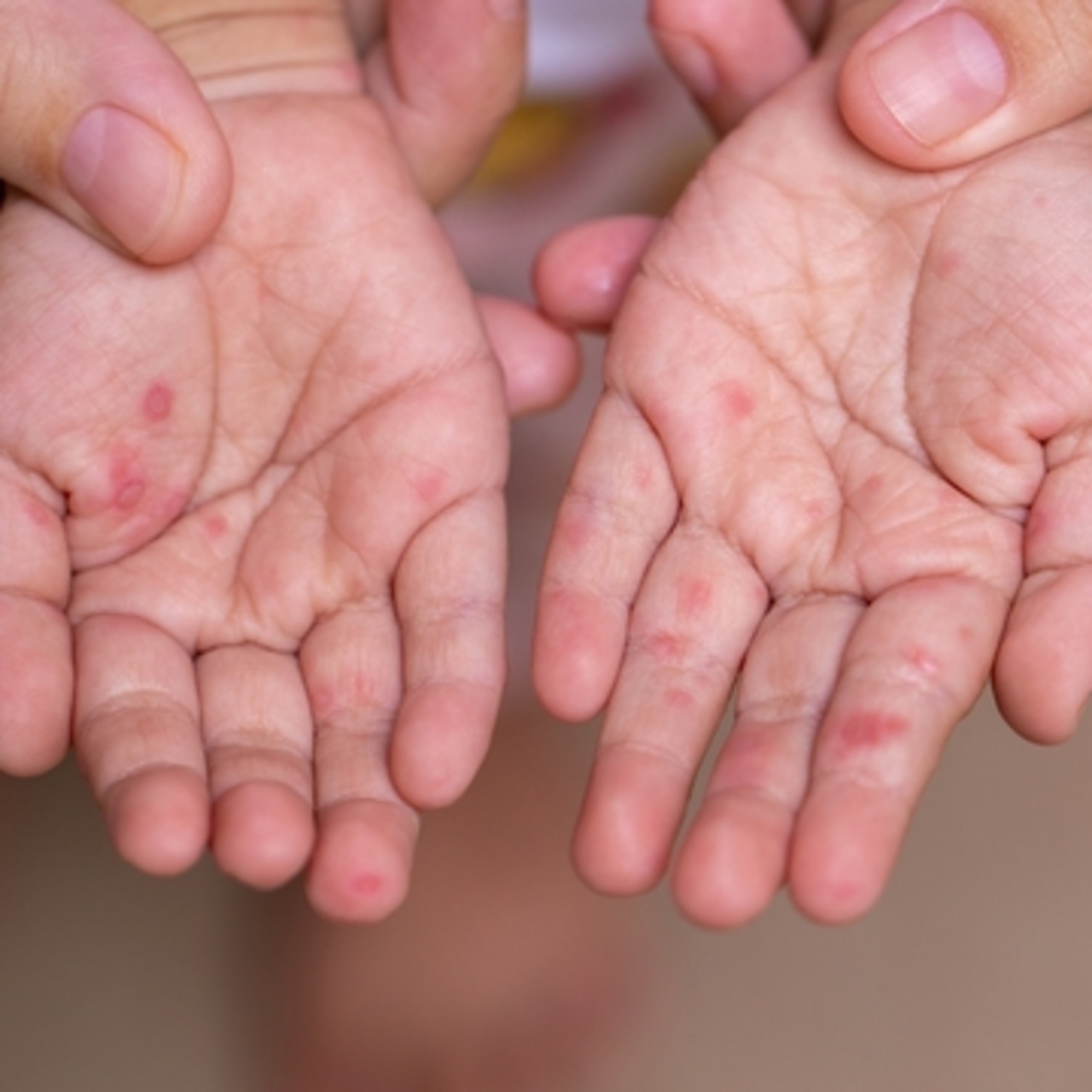 Japonya’da kızamık vakaları artıyor