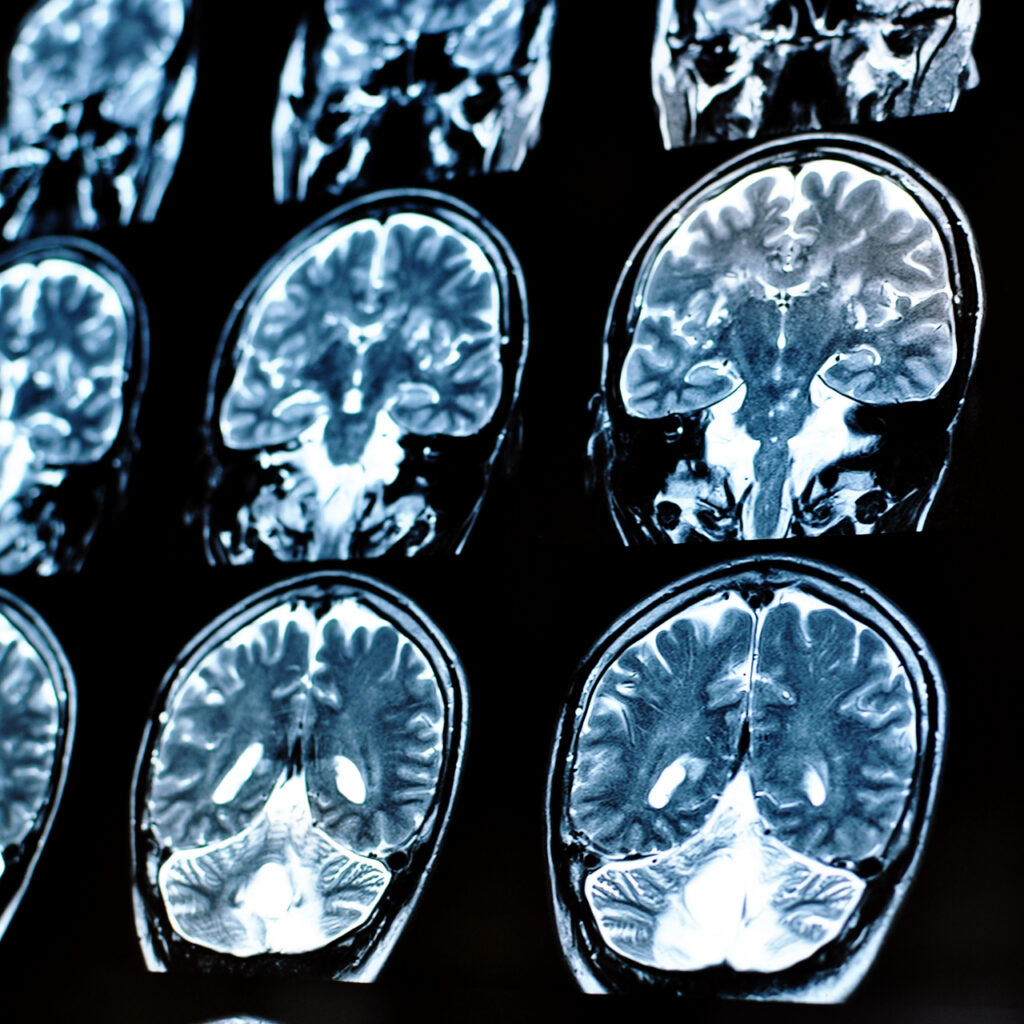 Uyku ilacı, Alzheimer ile ilişkili proteinlerin birikimini azaltabilir