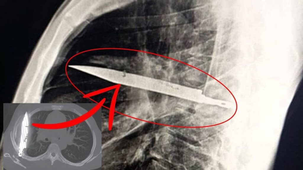 8 yıl boyunca göğsünde bıçakla yaşadı: Doktorlar bile fark etmedi