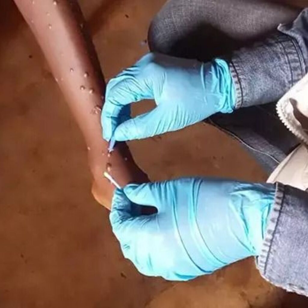 Gana’da M-çiçeği vaka sayısı 302’ye yükseldi