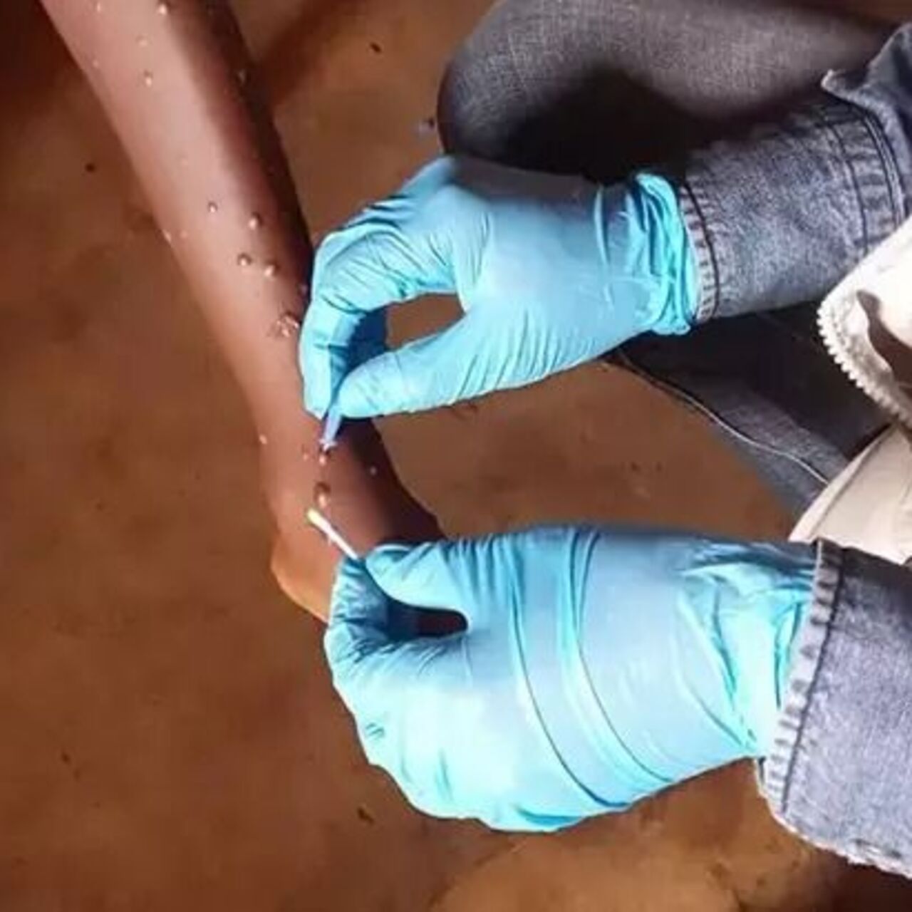 Gana’da M-çiçeği vaka sayısı 302’ye yükseldi