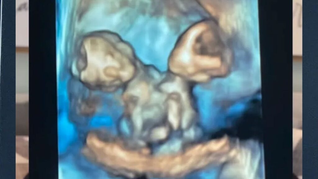 Yapışık ikiz doğuracağını öğrendi: Zor seçimi yaptı