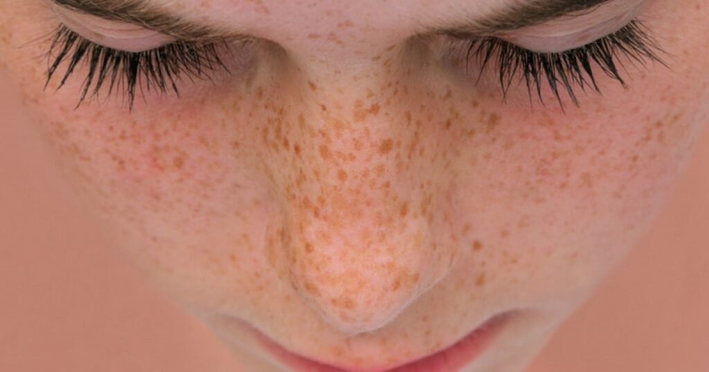 Yaz sonrası cilt lekesi artanlar dikkat