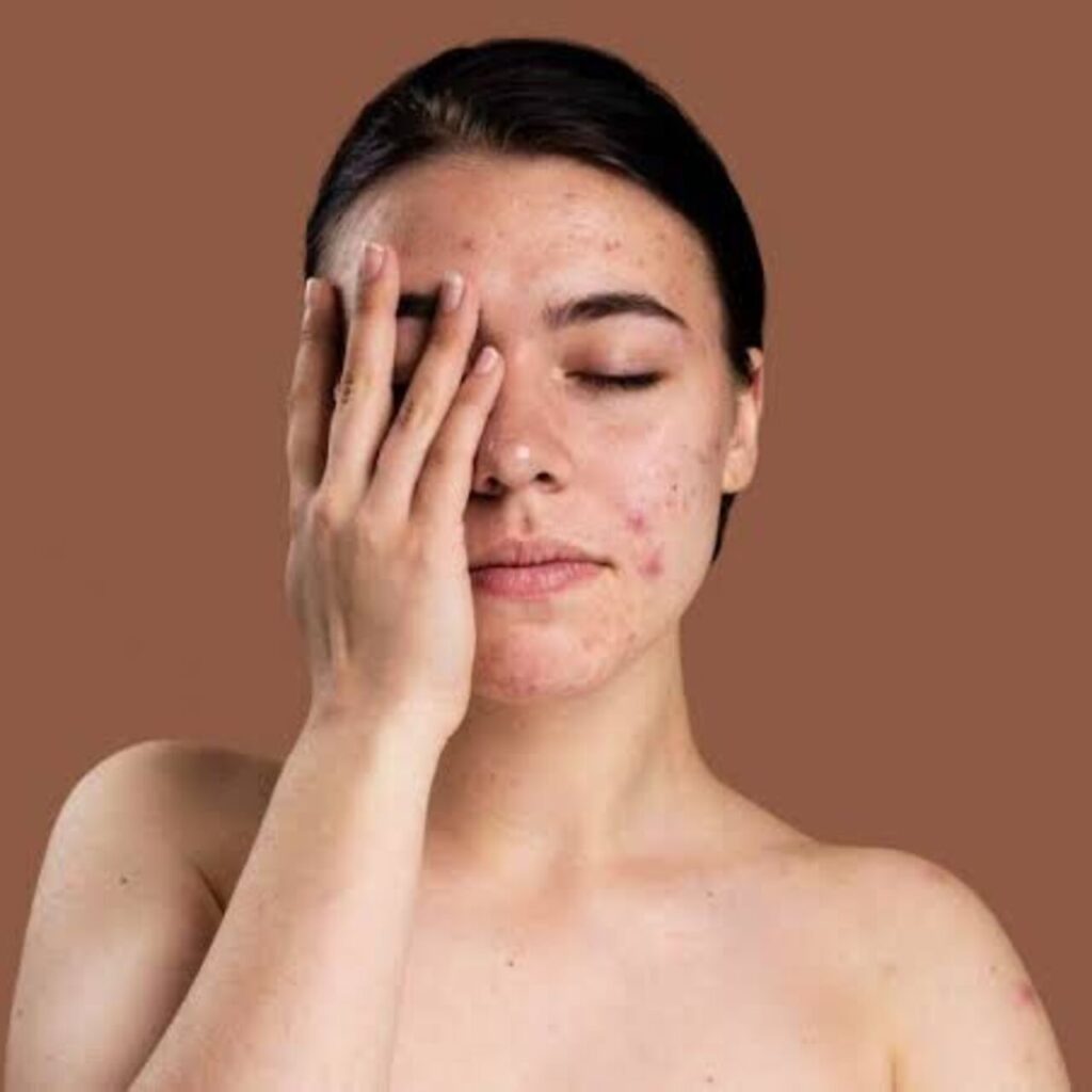 Doğal formüller ve gelişmiş teknolojiler yardımıyla kuru ve lekeli cildinizden kurtulun