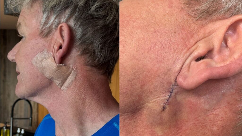 Dünyanın en ünlü şefi kanser oldu: ‘Kremi unutmayın’ uyarısı yaptı