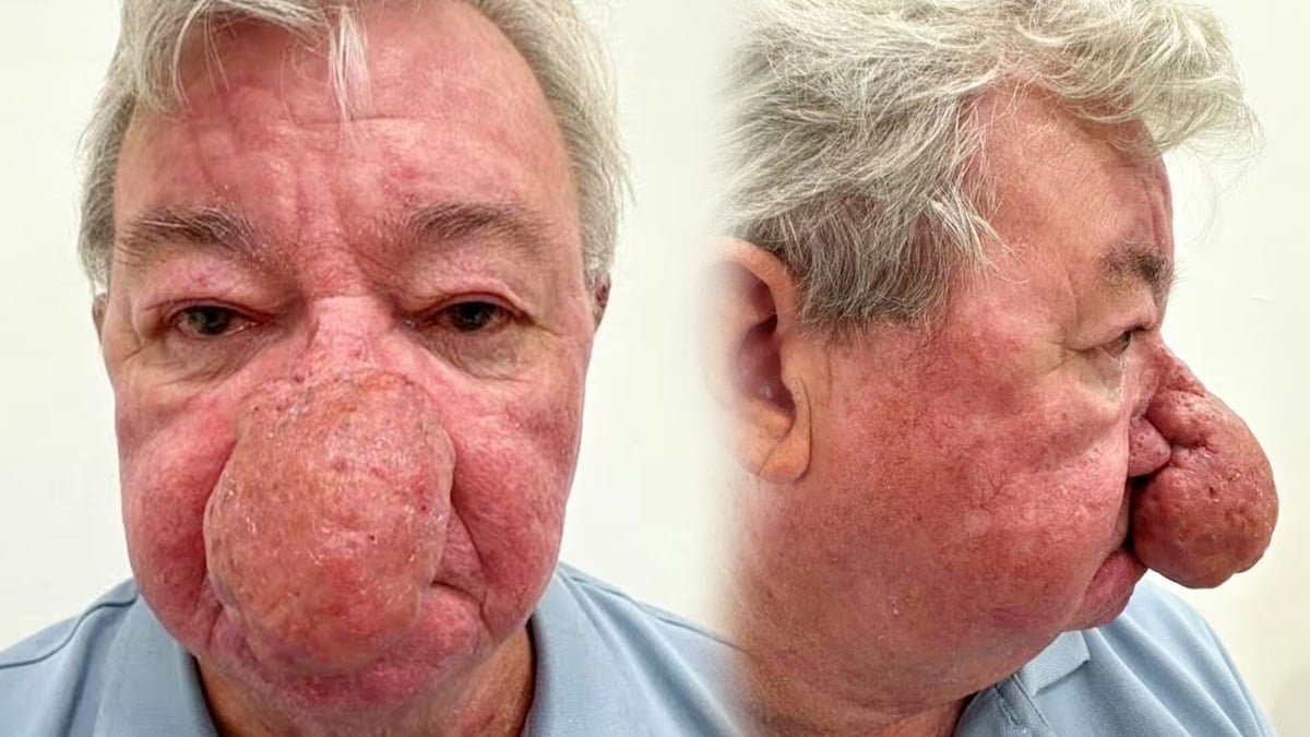 68 yaşındaki adamın burnu durmadan büyüyor