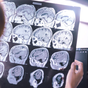 Birleşik Krallık’ta Parkinson teşhisi krizi