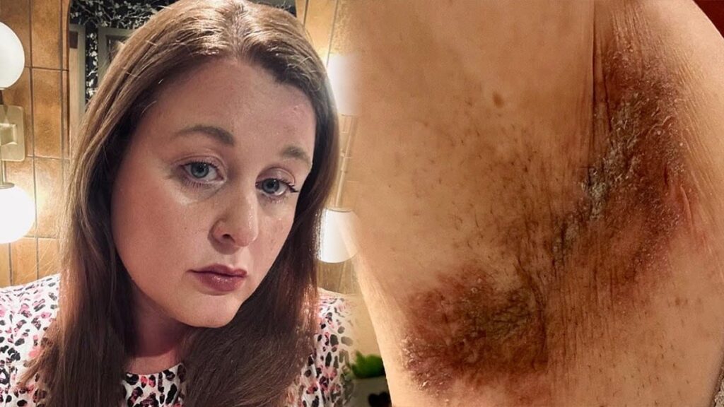 ‘Cildi yakan deodorant’ için dava açıldı: ‘Bir kez kullandım, yanma hissettim’