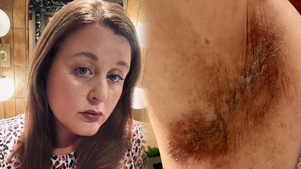 ‘Cildi yakan deodorant’ için dava açıldı: ‘Bir kez kullandım, yanma hissettim’