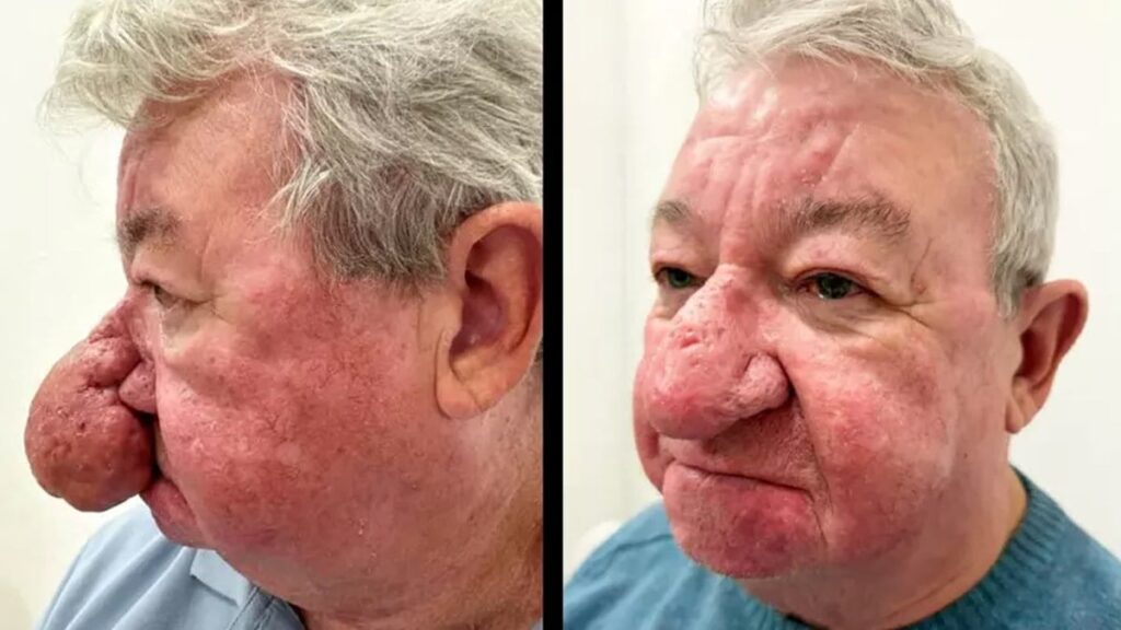 Doktorlar umursamadı, talihsiz adamın burnu her gün daha da büyüdü