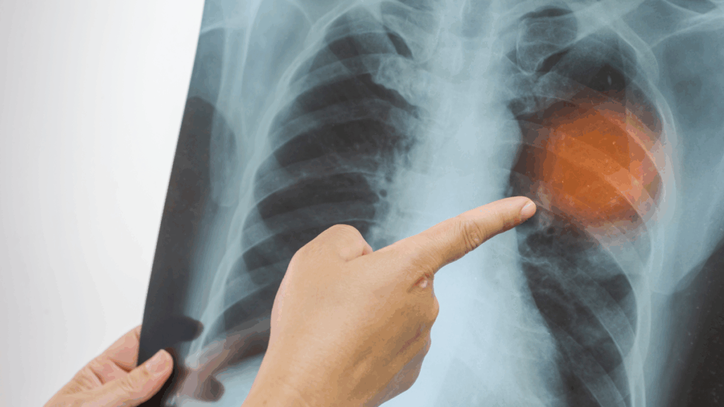 Hemen hastaneye gitmenizi gerektiren zatürre belirtileri: Çoğu kişi farkında bile değil