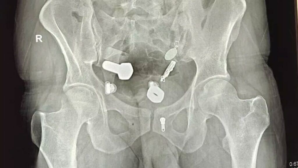 Midesi nalbura dönmüş! Karın ağrısıyla gittiği doktorda gerçek ortaya çıktı