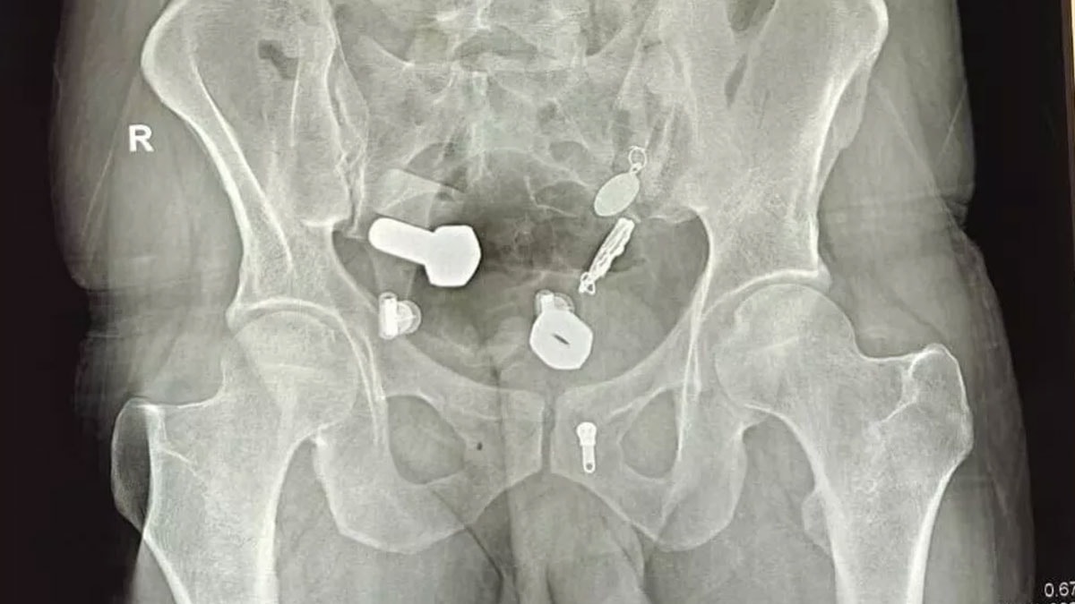 Midesi nalbura dönmüş! Karın ağrısıyla gittiği doktorda gerçek ortaya çıktı